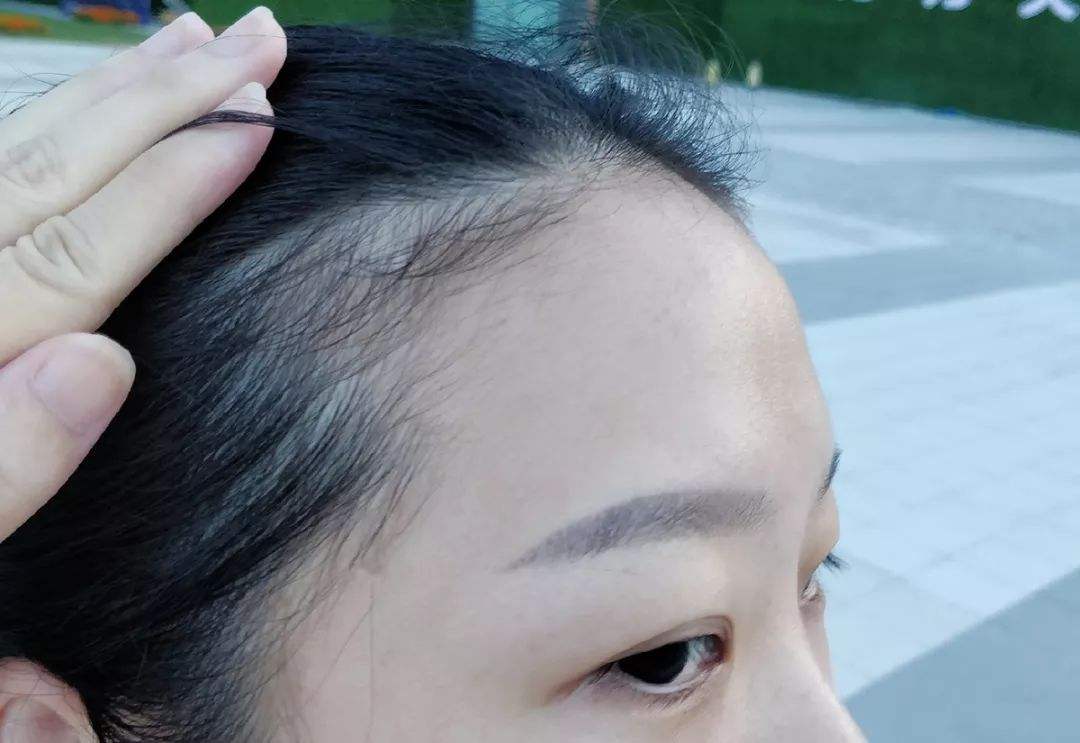 什么是拔毛癖？為什么一焦慮就拔頭發(fā)？